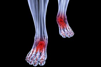 arthritic-foot-care